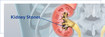 Complex Kidney Stones