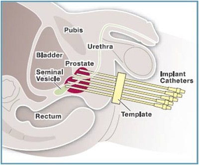 implant-catheters