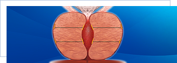 prostatic-urethral-lift